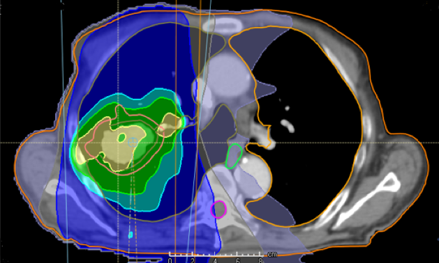Treatment with photons. X-ray image